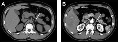 Case Report: The ectopic pancreas in the adrenal glands: It was found due to elevated blood pressure and initially diagnosed as adrenal adenoma